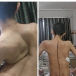 يمكنكم التواصل معنا لو تبحثون عن افضل دكتور للعمود الفقري أو افضل مستشفى في الهند للعمود الفقري، انزلاق عمود فقري، تقويم الفقرات بالهند، دلهي، مومباي، بنجلور